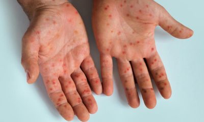 Measles outbreak sparks global concern