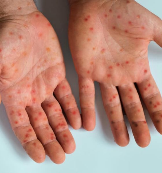 Measles outbreak sparks global concern